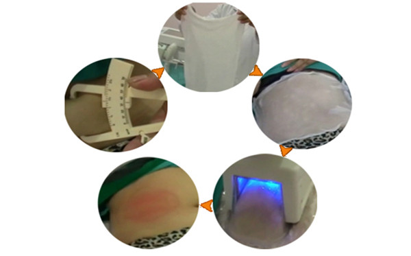 Cryo の処置 procedure.jpg